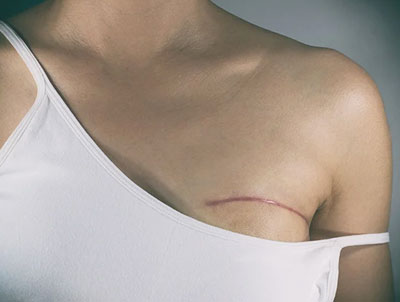 Breast Cancer Surgery